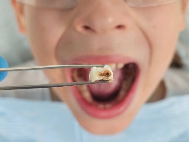 Best Emergency Treatment for Toothache in Keller, TX